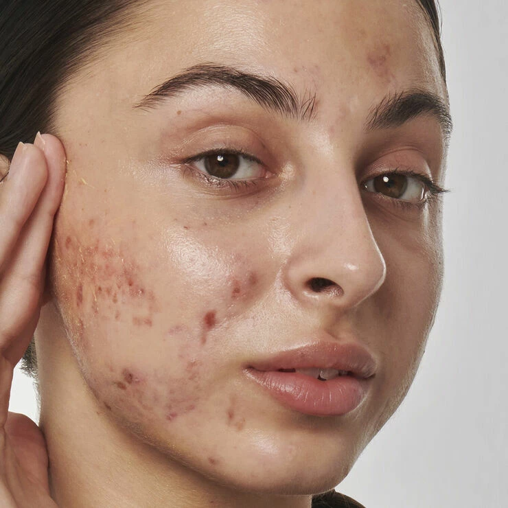 THE INKEY LIST Scar, Mark And Wrinkle Solution With 1% Retinol - Face Serum - Billede 4