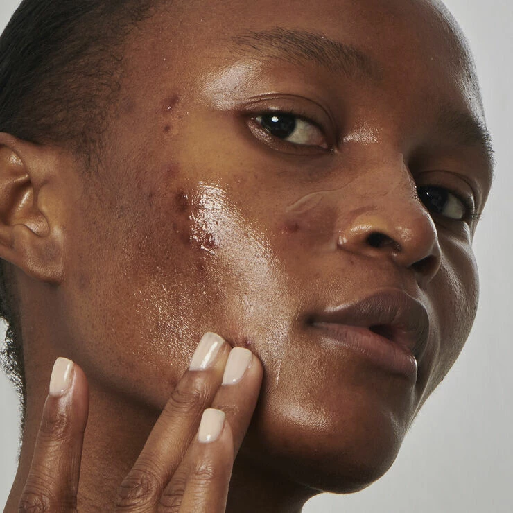THE INKEY LIST Excess Oil Solution With 20% Niacinamide - Face Serum 4 THE INKEY LIST Excess Oil Solution With 20% Niacinamide - Face Serum - Billede 4